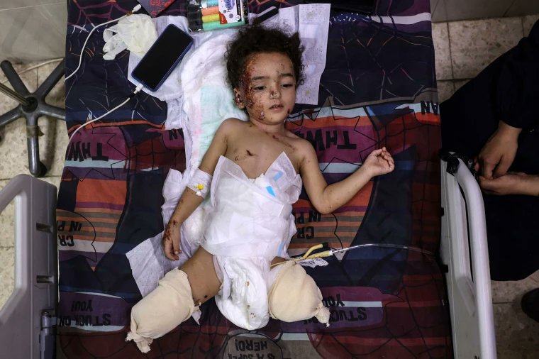 Gaza Menyandang Gelar Suram: Anak-Anak dengan Amputasi Tertinggi di Dunia